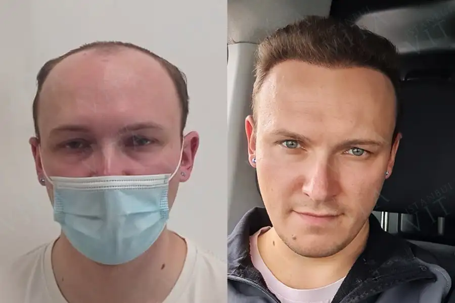 antes y después del trasplante de cabello